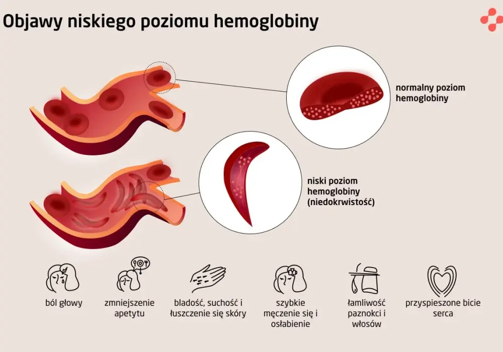 Niska hemoglobina - kiedy to alarm? Krytyczny poziom i objawy