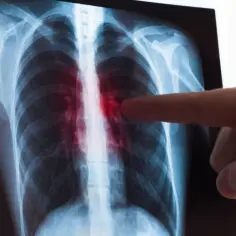 RTG klatki piersiowej z zaznaczonymi licznymi drobnymi guzkami w płucach.