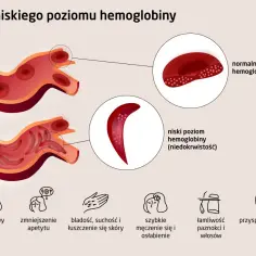 Ilustracja pokazuje normalne i sierpowate krwinki czerwone, wskazując na krytyczny poziom hemoglobiny. Objawy to ból głowy, bladość i szybkie męczenie.