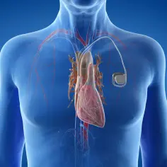 Anatomical view of a human heart with a pacemaker. Zastanawiasz się, ile się czeka na wszczepienie rozrusznika serca?
