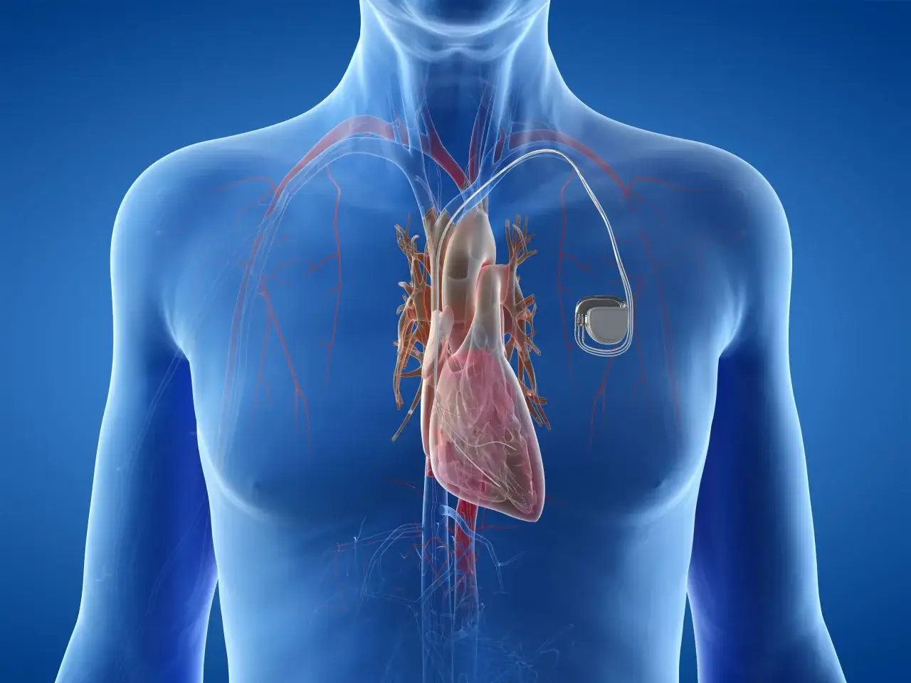 Anatomical view of a human heart with a pacemaker. Zastanawiasz się, ile się czeka na wszczepienie rozrusznika serca?