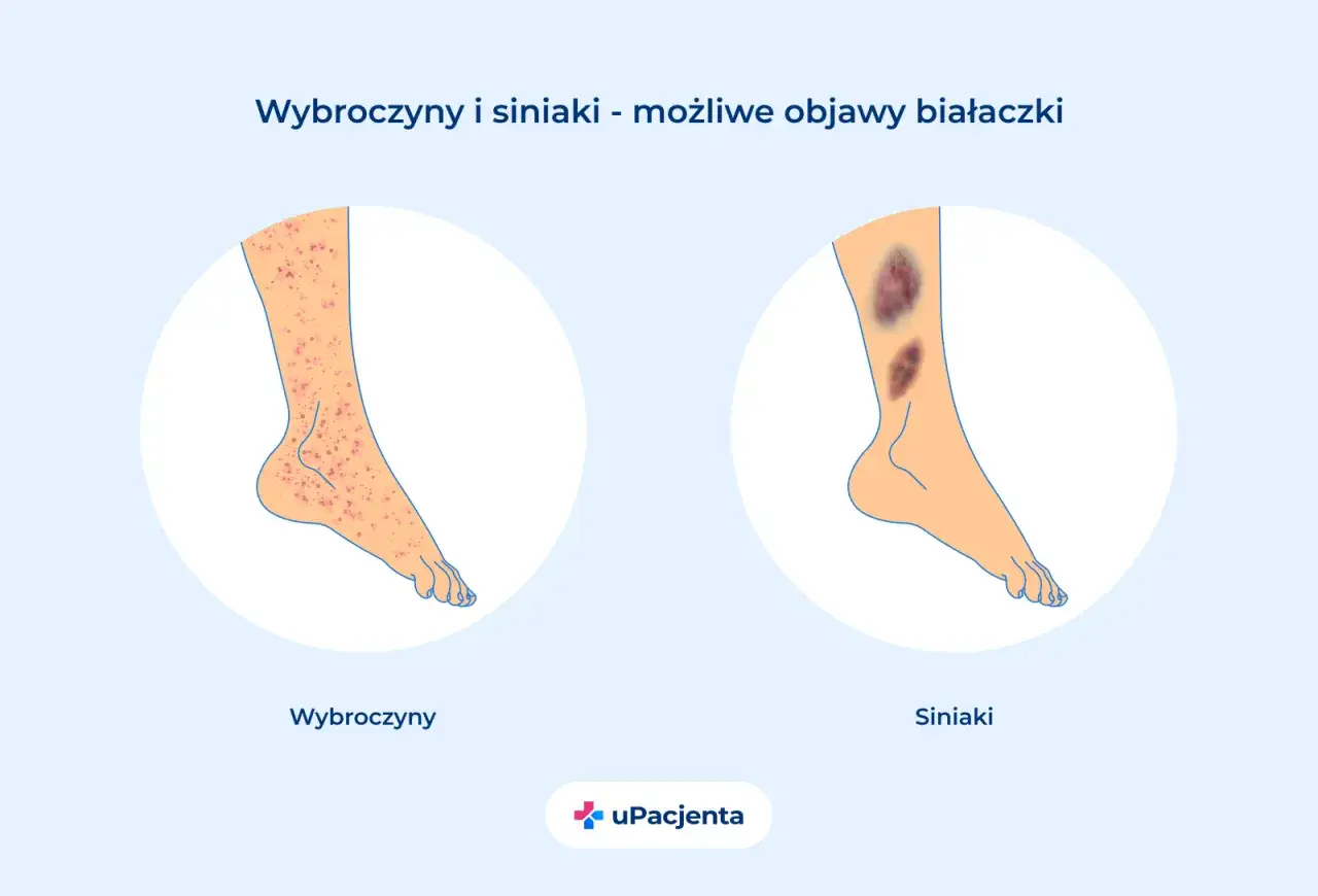 Wybroczyny i siniaki na nogach mogą być objawem białaczki. Lewa noga pokazuje liczne czerwone plamki, prawa - ciemne siniaki.