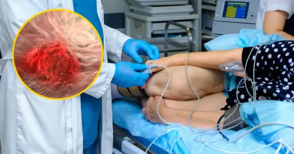Po leczeniu raka jelita grubego - co dalej i na co uważać?