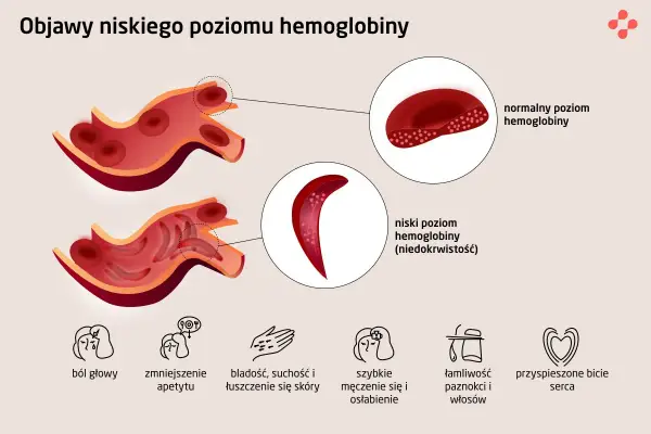 Niska hemoglobina - kiedy to alarm? Krytyczny poziom i objawy