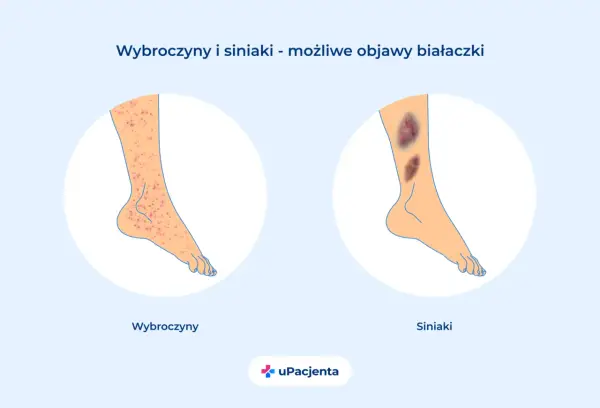 Ostra białaczka szpikowa - objawy, rozpoznanie i leczenie